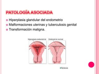 Hiperplasia glandular del endometrio
 Malformaciones uterinas y tuberculosis genital
 Transformación maligna.


 
