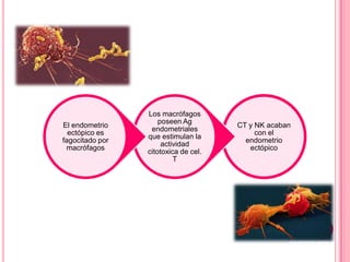 CT y NK acaban
con el
endometrio
ectópico
Los macrófagos
poseen Ag
endometriales
que estimulan la
actividad
citotoxica de cel.
T
El endometrio
ectópico es
fagocitado por
macrófagos
 
