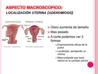 LOCALIZACIÓN UTERINA (ADENOMIOSIS)
 Útero aumenta de tamaño
 Mas pesado
 A corte podemos ver 3
formas
 Engrosamiento difuso de la
pared
 Localizado, semejando un
mioma
 Masa polipode que hace
relieve en la cavidad uterina
 