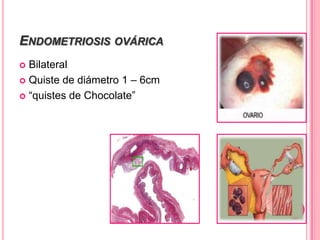 ENDOMETRIOSIS OVÁRICA
 Bilateral
 Quiste de diámetro 1 – 6cm
 “quistes de Chocolate”
 