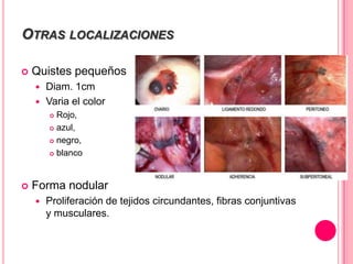 OTRAS LOCALIZACIONES
 Quistes pequeños
 Diam. 1cm
 Varia el color
 Rojo,
 azul,
 negro,
 blanco
 Forma nodular
 Proliferación de tejidos circundantes, fibras conjuntivas
y musculares.
 