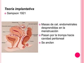 Teoría implantativa
 Sampson 1921
 Masas de cel. endometriales
desprendidas en la
menstruación
 Pasan por la trompa hacia
cavidad peritoneal
 Se anclan
 
