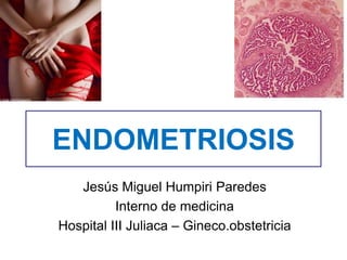 ENDOMETRIOSIS
Jesús Miguel Humpiri Paredes
Interno de medicina
Hospital III Juliaca – Gineco.obstetricia
 