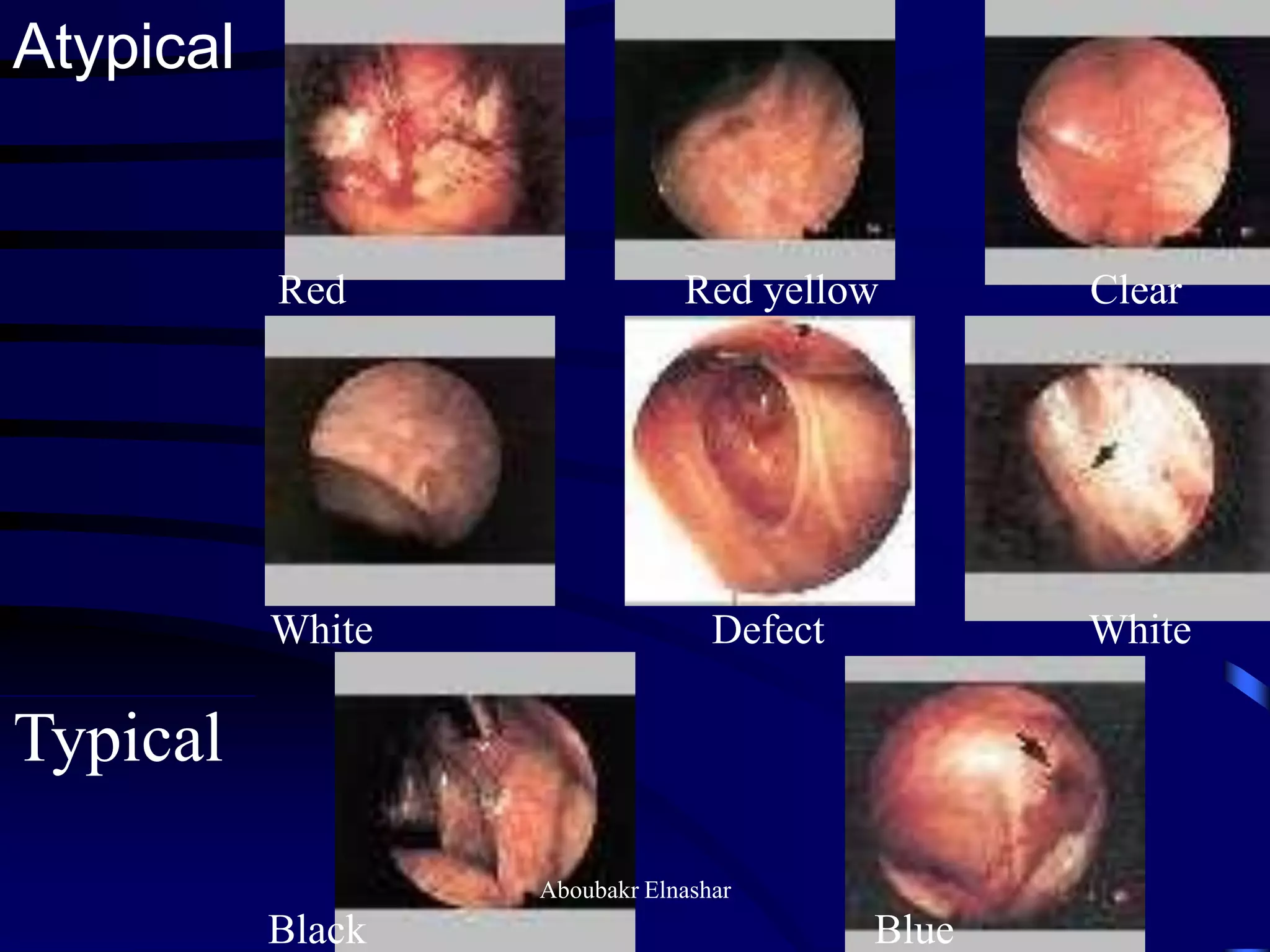 Atypical
Typical
Red Red yellow Clear
White Defect White
Black Blue
Aboubakr Elnashar
 