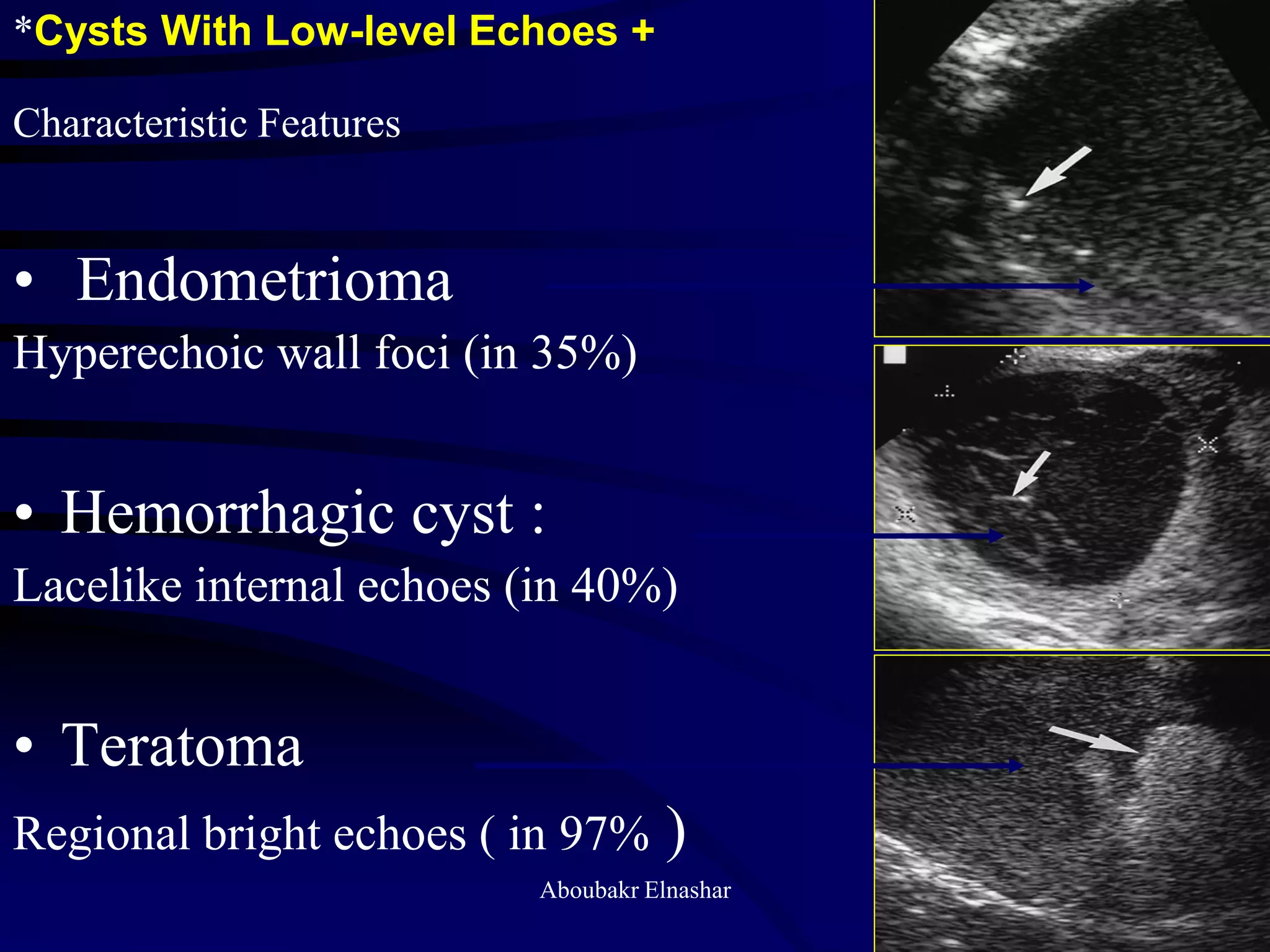 • Endometrioma
Hyperechoic wall foci (in 35%)
• Hemorrhagic cyst :
Lacelike internal echoes (in 40%)
• Teratoma
Regional bright echoes ( in 97% )
*Cysts With Low-level Echoes +
Characteristic Features
Aboubakr Elnashar
 