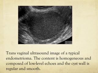 Deep endometriosis with bowel involvement : 
presence of hypo echoic mass with recto sigmoid 
involvement characterised by...