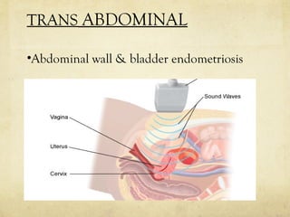 Sagittal trans abdominal pelvic ultrasound: an irregular 
hypoechoic mass situated anterior to uterus 
invaginating the ur...