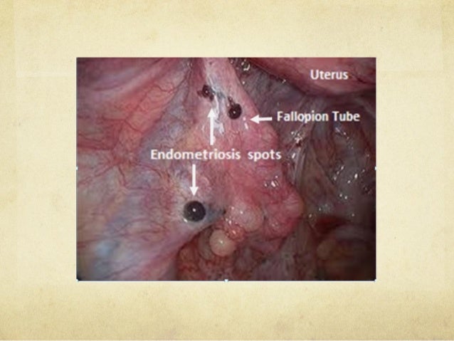 Endometriosis