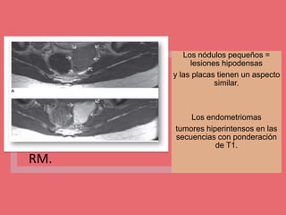 RM.
Los nódulos pequeños =
lesiones hipodensas
y las placas tienen un aspecto
similar.
Los endometriomas
tumores hiperintensos en las
secuencias con ponderación
de T1.
 