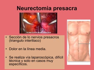 Neurectomia presacra
• Sección de lo nervios presacros
(triangulo interiliaco)
• Dolor en la línea media.
• Se realiza vía laparoscópica, difícil
técnica y solo en casos muy
específicos.
 