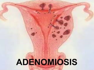 ADENOMIOSIS
 