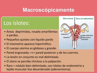 Macroscópicamente
Los islotes:
• Áreas deprimidas, rosado amarillentas
o pardas.
• Pequeños quistes con líquido pardo
• El miometrio aparece hipertrófico.
• El cuerpo uterino es globoso y grande.
• Pared engrosada; +++ pared posterior y de los cuernos.
• La lesión en conjunto es mal delimitada.
• El útero se percibe chicloso a la palpación.
• Raro = nódulo bien delimitado, con islotes de endometrio y
tejido muscular liso desordenado (adenomioma).
 