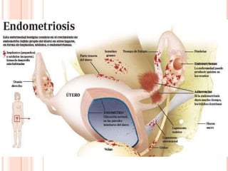 ENDOMETRIOSIS
 