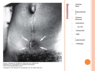 DIAGNÓSTICO
1. -Examen
físico.
2. -
Especuloscopí
a
3. -Examen
bimanual
4. -Laboratorio:
5. Ca 125.
6. - Ultrasonido
7. - IRM
8. -
Laparoscopía
9. - Histología
 