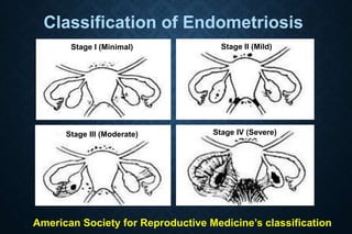 Stage I (Minimal) Stage II (Mild)
Stage III (Moderate) Stage IV (Severe)
Classification of Endometriosis
American Society for Reproductive Medicine’s classification
 