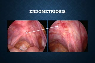 ENDOMETRIOSIS
 