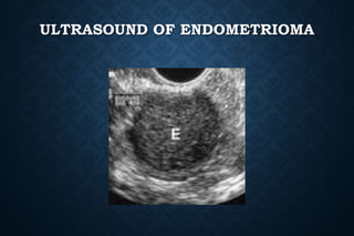ULTRASOUND OF ENDOMETRIOMA
 