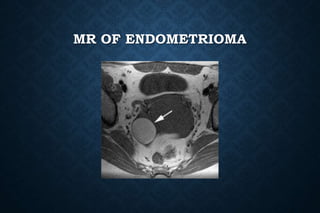 MR OF ENDOMETRIOMA
 
