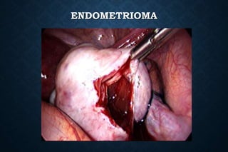 ENDOMETRIOMA
 