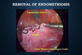 REMOVAL OF ENDOMETRIOSIS
 