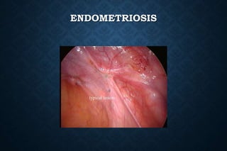 ENDOMETRIOSIS
 