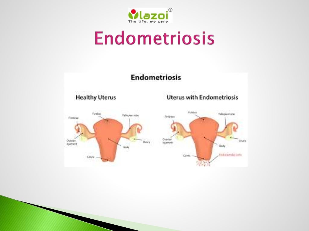 endometriosis