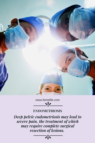 Deep pelvic endometriosis may lead to
severe pain, the treatment of which
may require complete surgical
resection of lesions. 
ENDOMETRIOSIS
www.femelife.com
 