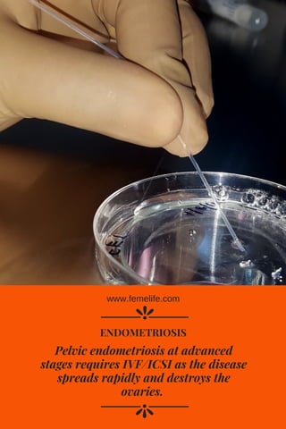 Pelvic endometriosis at advanced
stages requires IVF/ICSI as the disease
spreads rapidly and destroys the
ovaries. 
ENDOMETRIOSIS
www.femelife.com
 