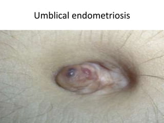 Umblical endometriosis
 