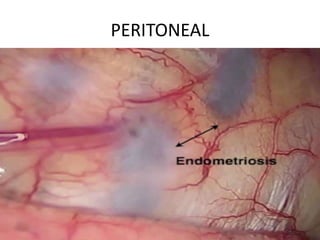 PERITONEAL
 