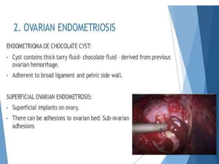 Endometriosis