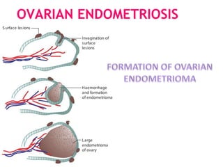 OVARIAN ENDOMETRIOSIS
 