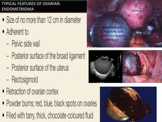 TYPICAL FEATURES OF OVARIAN
ENDOMETRIOMA
 