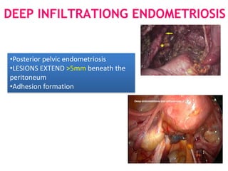 DEEP INFILTRATIONG ENDOMETRIOSIS
•Posterior pelvic endometriosis
•LESIONS EXTEND >5mm beneath the
peritoneum
•Adhesion formation
 