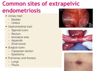 Common sites of extrapelvic
endometriosis
 