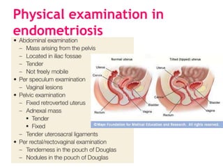 Physical examination in
endometriosis
 