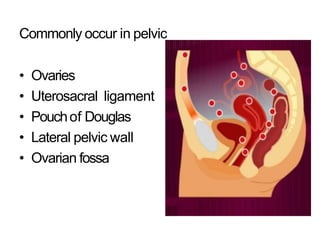 Commonly occur in pelvic
• Ovaries
• Uterosacral ligament
• Pouchof Douglas
• Lateral pelvic wall
• Ovarian fossa
 