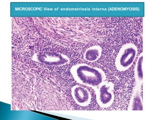 MICROSCOPIC View of endometriosis interna (ADENOMYOSIS)
 