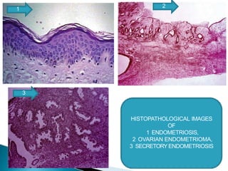 HISTOPATHOLOGICAL IMAGES
OF
1 ENDOMETRIOSIS,
2 OVARIAN ENDOMETRIOMA,
3 SECRETORYENDOMETRIOSIS
1
2
3
 