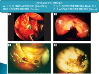 LAPROSCOPIC IMAGES:
A  OLD ENDOMETRIOSIS (Blue/Grey) B OLD ENDOMETRIOSIS (Red) C 
OLD ENDOMETRIOSIS (Brown) D  ACTIVE ENDOMETRIOSIS (Black)
 