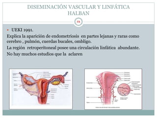 DISEMINACIÓN VASCULAR Y LINFÁTICA
HALBAN
 UEKI 1991.
Explica la aparición de endometriosis en partes lejanas y raras como
cerebro , pulmón, cuerdas bucales, ombligo.
La región retroperitoneal posee una circulación linfática abundante.
No hay muchos estudios que la aclaren
FR
 