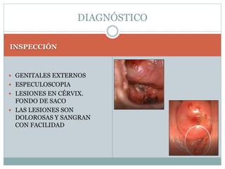 INSPECCIÓN
 GENITALES EXTERNOS
 ESPECULOSCOPIA
 LESIONES EN CÉRVIX.
FONDO DE SACO
 LAS LESIONES SON
DOLOROSAS Y SANGRAN
CON FACILIDAD
DIAGNÓSTICO
 