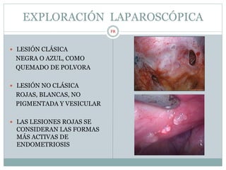 EXPLORACIÓN LAPAROSCÓPICA
 LESIÓN CLÁSICA
NEGRA O AZUL, COMO
QUEMADO DE POLVORA
 LESIÓN NO CLÁSICA
ROJAS, BLANCAS, NO
PIGMENTADA Y VESICULAR
 LAS LESIONES ROJAS SE
CONSIDERAN LAS FORMAS
MÁS ACTIVAS DE
ENDOMETRIOSIS
FR
 