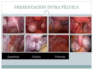 PRESENTACIÓN INTRA PÉLVICA
 