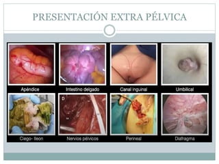 PRESENTACIÓN EXTRA PÉLVICA
 