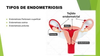 TIPOS DE ENDOMETRIOSIS
 Endometriosis Peritoneal o superficial
 Endometriosis ovárica
 Endometriosis profunda
 
