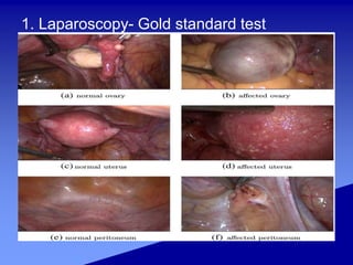 1. Laparoscopy- Gold standard test
 