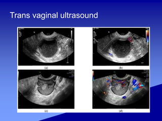Trans vaginal ultrasound
 