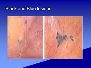 Black and Blue lesions
 