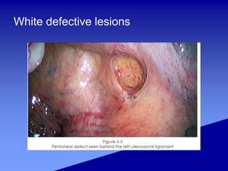 White defective lesions
 